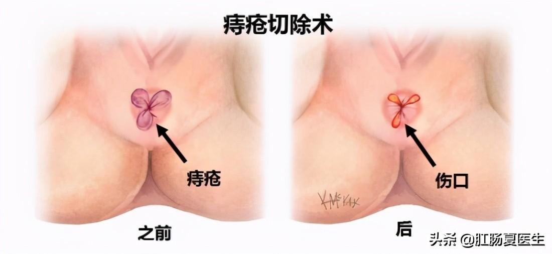 最新痔疮治疗方法与技术概述