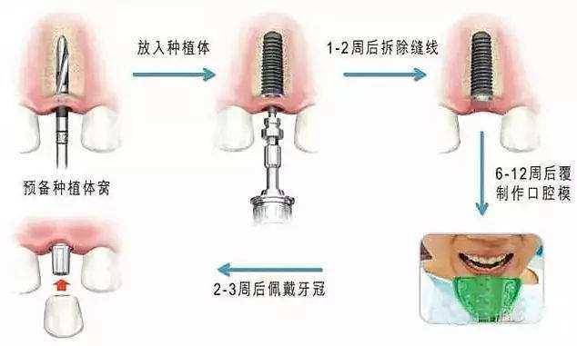 拔牙后几个月可种牙？全面解读植牙时间与流程