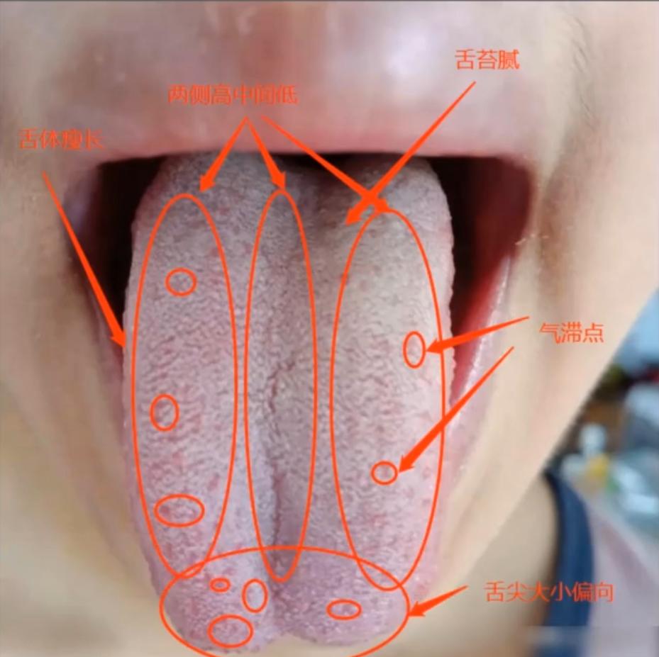 六个月宝宝舌尖红点观察与解析（附图片）