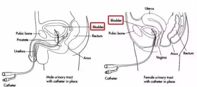 长期插尿管的风险及应对措施，插一个月尿管的潜在危害探讨