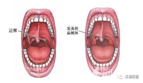 八个月宝宝扁桃体炎，了解、预防与治疗全攻略